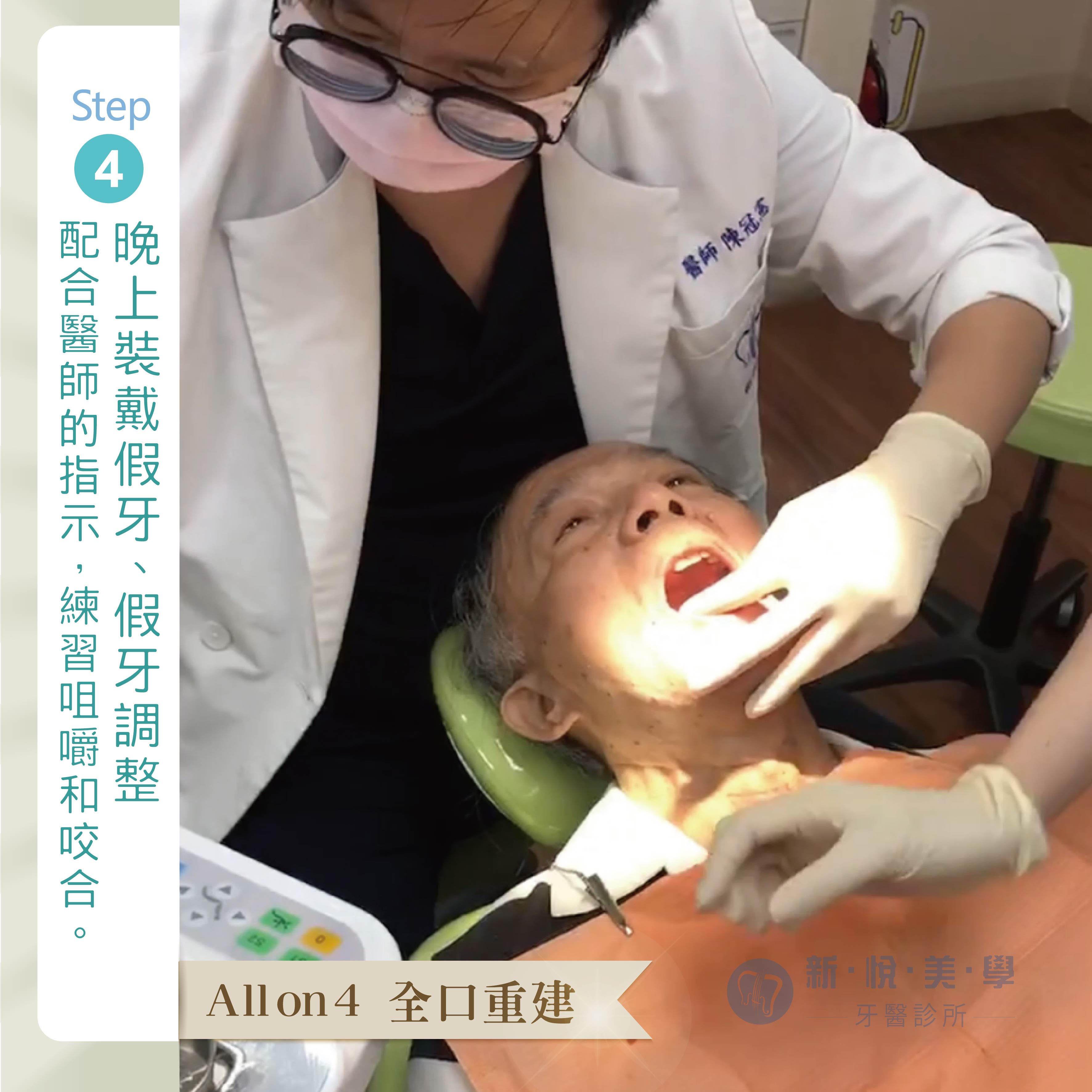 [新悅美學牙醫案例] 王老闆的 All on 4 微笑見證的第4張圖片